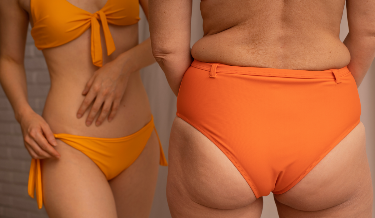 Kann man ein Lipödem wegtrainieren oder liegt das Problem tiefer? Kann man ein Lipödem wegtrainieren oder liegt das Problem tiefer?